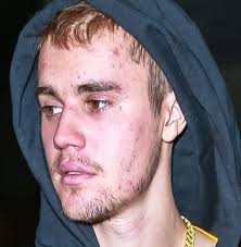Justin Bieber has recently been diagnosed with Lyme Disease and chronic mono, providing his fans with a reason for his recently unhealthy appearance. 